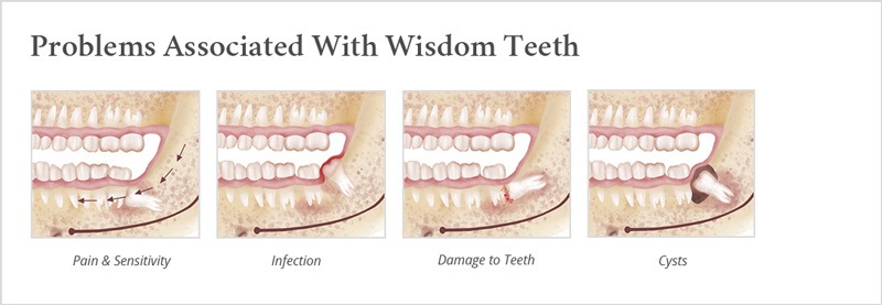 wisdom teeth